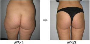 découvrez nos conseils et solutions efficaces pour éliminer la culotte de cheval. retrouvez une silhouette harmonieuse grâce à nos astuces minceur, exercices ciblés et méthodes naturelles pour affiner vos hanches durablement.
