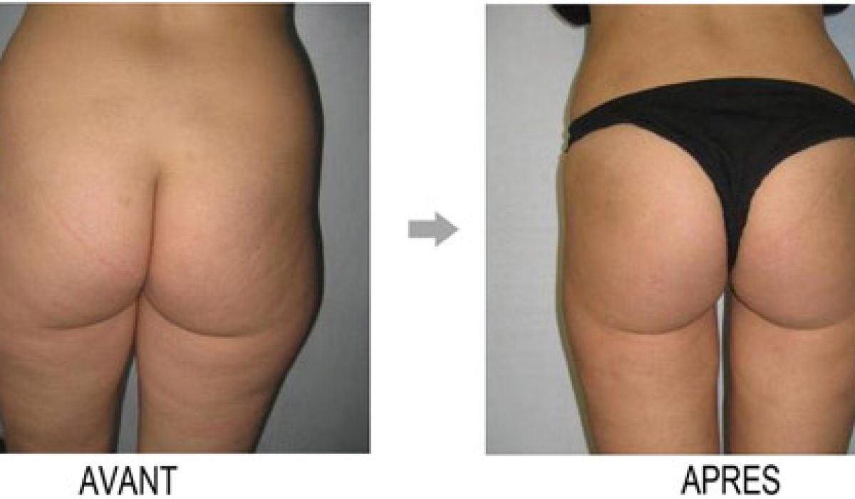 découvrez nos conseils et solutions efficaces pour éliminer la culotte de cheval. retrouvez une silhouette harmonieuse grâce à nos astuces minceur, exercices ciblés et méthodes naturelles pour affiner vos hanches durablement.